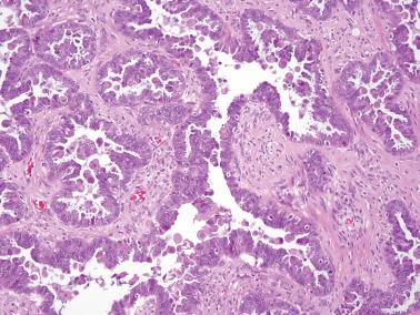 Fig. 13.11, Serous borderline tumor. A higher-power view shows the typical tufted papillae, many of which have apical cells with abundant eosinophilic cytoplasm.