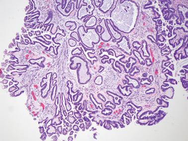 Fig. 13.14, Serous borderline tumor. Dilated tubular glands appear somewhat endometrioid in character, a feature not uncommon in serous borderline tumors.