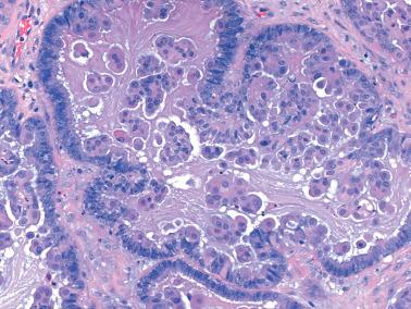 Fig. 13.16, Serous borderline tumor. Note the luminal mucin and abundant eosinophilic cytoplasm of the tumor cells.