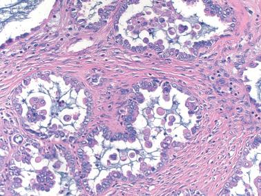 Fig. 13.18, Serous borderline tumor. Cells with abundant eosinophilic cytoplasm, rarely seen in carcinoma, are conspicuous.