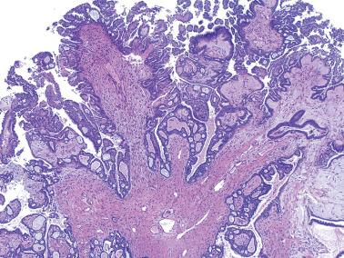 Fig. 13.20, Serous borderline tumor: A cribriform pattern is conspicuous in a tumor which otherwise has a classic papillary pattern (see top and upper right).