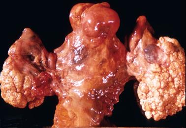 Fig. 13.2, Bilateral serous surface papillomas (a subserosal leiomyoma is present in the uterine fundus).