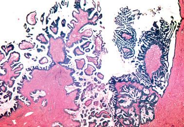 Fig. 13.22, The low-power appearance of micropapillary serous borderline tumor (right) contrasts with that of typical serous borderline tumor (left).