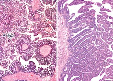 Fig. 13.23, Micropapillary serous borderline tumor. Left: Typical ‘medusa head’ appearance. Right: Long thin epithelial papillae without stromal cores.