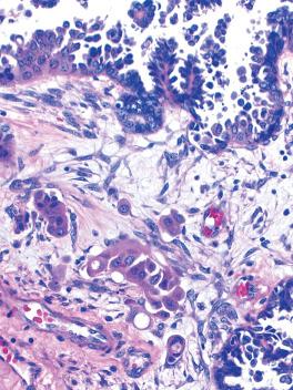 Fig. 13.24, Serous borderline tumor with microinvasion. Left: Glandular and papillary aggregates lie within the stroma of a papilla. Center: The microinvasive cells have appreciable eosinophilic cytoplasm. Right: The microinvasive cells are present as single cells and in small clusters.