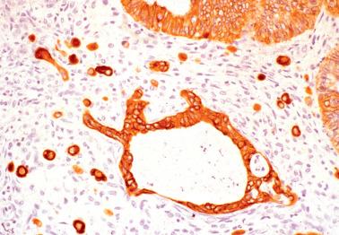 Fig. 13.25, Serous borderline tumor with microinvasion. A cytokeratin stain highlights many singly disposed invasive epithelial cells that were not as apparent on the H&E-stained section.