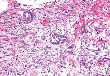 Fig. 13.27, Autoimplant (same case as illustrated in previous photo). Only two small nests of neoplastic epithelium are present within an exuberant desmoplastic stroma.