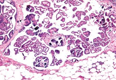 Fig. 13.29, Noninvasive epithelial implant of serous borderline tumor on the omentum.