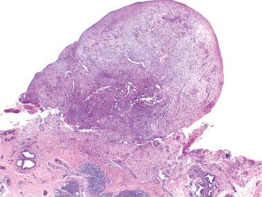 Fig. 13.30, Noninvasive desmoplastic impact of serous borderline tumor. Many examples form a discrete nodule as seen here. Note prominence of stroma over epithelial cells and well-demarcated base.