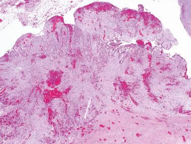 Fig. 13.31, Noninvasive desmoplastic implant of serous borderline tumor. Note the prominent reactive stroma with conspicuous hemorrhage.