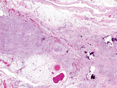 Fig. 13.32, Noninvasive desmoplastic implant of serous borderline tumor. The epithelial cells and associated reactive stroma expand the septum between two lobules of omental fat.