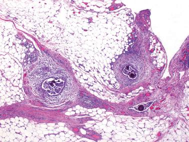 Fig. 13.33, Noninvasive desmoplastic implant of serous borderline tumor. Reactive stroma forms a distinct cuff around the implant epithelium.