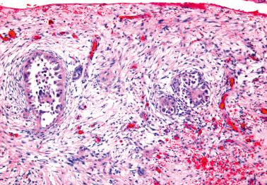 Fig. 13.34, Noninvasive desmoplastic omental implant of serous borderline tumor. The presence or absence of invasion in this field cannot be determined because the border of the implant with the underlying normal tissue cannot be seen.