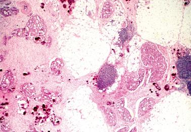 Fig. 13.35, Invasive implant of serous borderline tumor. Cellular foci of tumor, some with a cribriform pattern, invade the omental fat. A focal desmoplastic response (left), lymphoid aggregates (right), and many psammoma bodies are also present.