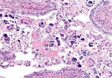 Fig. 13.36, Ovarian serous borderline tumor involving a fallopian tube. Tumor papillae and numerous psammoma bodies are within the lumen.