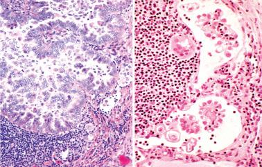 Fig. 13.37, Serous borderline tumor involving pelvic lymph nodes, two different cases. Left: Most of the tumor involves the nodal parenchyma but some tumor cells are present within subcapsular lymphatics (extreme right in same image). Right: Papillary clusters of tumor occupy subcapsular lymphatics.