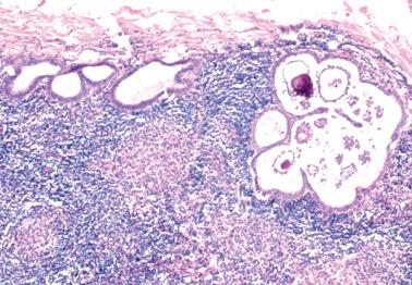 Fig. 13.38, Intranodal serous borderline tumor. A focus of tumor (right) is associated with intranodal endosalpingiosis (left) from which it likely originated.