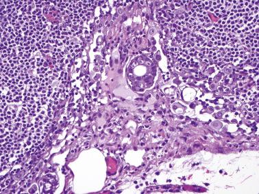 Fig. 13.40, Metastatic low-grade serous carcinoma involving the peripheral sinus of a lymph node.