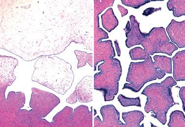 Fig. 13.4, Papillary serous cystadenoma. Left: Stromal papillae, some of which are markedly edematous (a finding that can impart a hydropic appearance on gross examination), project into a cyst lumen. Right: Variably cellular fibrous papillae are covered by a single layer of columnar epithelium that on high-power examination was focally ciliated.