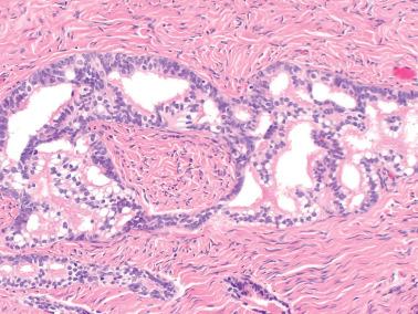 Fig. 13.5, Serous adenofibroma. This example had an unusually prominent pattern of small glands with a cribriform arrangement. Cilia and bland cytologic features are apparent.