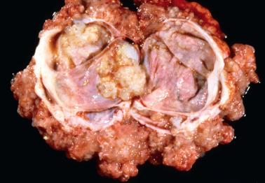 Fig. 13.6, Serous borderline tumor, sectioned surface. Multiple velvety papillae cover the serosa and focally line a cyst lumen.