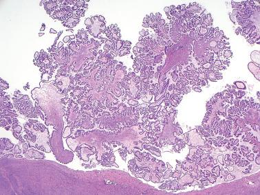 Fig. 13.7, Serous borderline tumor. This example demonstrates the progressive hierarchical branching typical of a serous borderline tumor of the usual type.