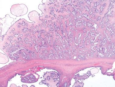 Fig. 13.8, Serous borderline tumor. This example has a prominent fibrous stroma with the epithelial component invaginating within it.