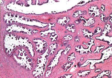 Fig. 13.10, Serous borderline tumor with orderly pattern of invagination. The small gland-like spaces separated by a fibromatous stroma should not be mistaken for stromal invasion.