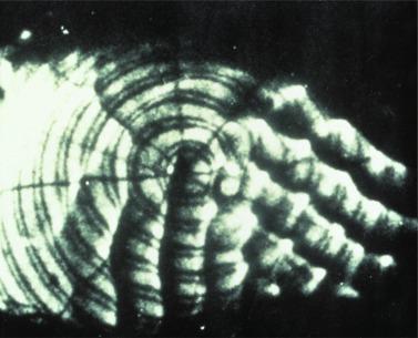 Fig. 21.3, Photokeratogram of a cornea displaying epithelial wrinkling.