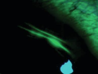 Fig. 21.6, Epithelial wrinkling highlighted with fluorescein and observed in cobalt blue light (same case as in Fig. 21.4 ).