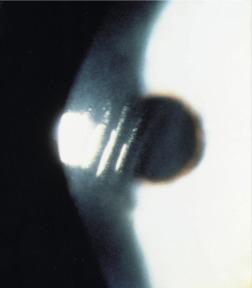 Fig. 21.7, Epithelial wrinkling of the central cornea after removal of a lens of 42.5% water content and of 0.035 mm centre thickness.