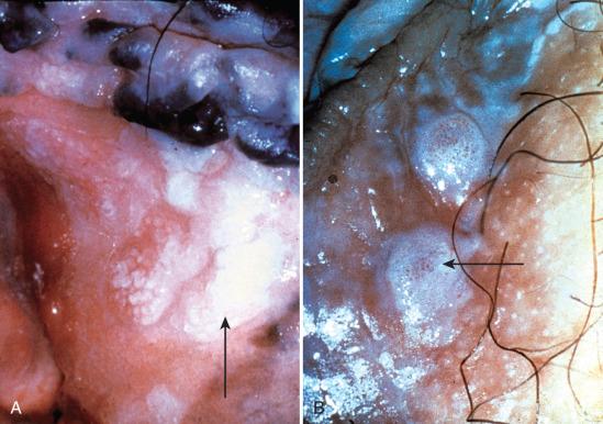 Fig. 12.1, A, Low-grade vaginal squamous intraepithelial lesion, with hyperkeratosis (arrow). B, Acetowhite lesions (arrow) with punctuation.