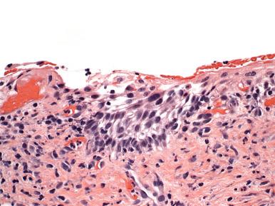 Fig. 12.11, High-grade squamous intraepithelial lesion mimic—marked inflammatory atypia, resembling a thin dysplasia in immature squamous metaplasia.