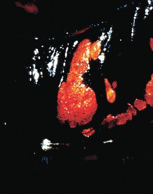 Fig. 12.2, High-grade vaginal squamous intraepithelial lesions, conspicuous for the absence of Lugol's solution uptake.