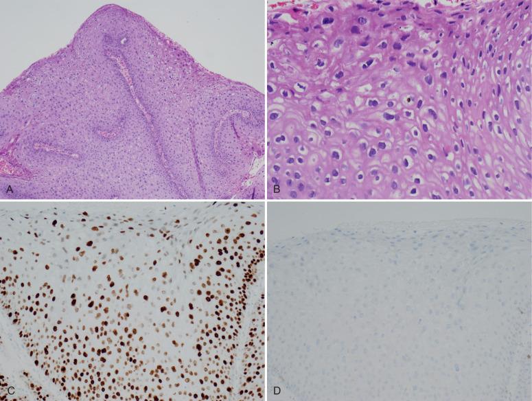 Fig. 12.3, Low-grade vaginal squamous intraepithelial lesion, exophytic condyloma. A, Low magnification. B, At higher power, showing prominent cytopathic effect (koilocytosis). C, Near full-thickness staining for MIB-1, typical when there is prominent cytopathic effect. D, A p16 immunostain is negative. These immunostains are illustrative of these low-risk human papillomavirus–associated lesions; however, they are not necessary in practice.