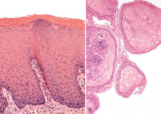 Fig. 12.5, Differential diagnosis of a low-grade vaginal squamous intraepithelial lesion. A, Nonspecific acanthosis and hyperkeratosis. B, Mucosal excrescences near the hymenal ring.