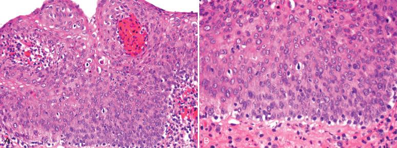 Fig. 12.6, A, Low-grade vaginal squamous intraepithelial lesion (vaginal intraepithelial neoplasia, grade 1), exhibiting some expansion of the lower cell layers but a polarized cell population. B, Higher power view of A illustrates a relatively uniform population, with mild hyperchromasia and uniformly distributed chromatin with nucleoli.