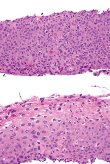 Fig. 12.7, A, This tangentially sectioned vaginal squamous intraepithelial lesion exhibits some mitoses in the upper cell layers, raising suspicion for vaginal intraepithelial neoplasia grade 2 ((VAIN 2; high-grade squamous intraepithelial lesion). B, However, additional sections depict a lesion more in keeping with VAIN 1 (low-grade squamous intraepithelial lesion).