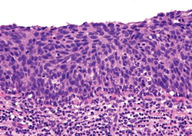 Fig. 12.8, High-grade squamous intraepithelial lesion (vaginal intraepithelial neoplasia grades 2 and 3). There is full-thickness atypia.