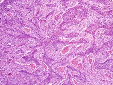 Figure 6.1, Biphasic Synovial Sarcoma.