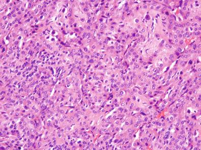 Figure 6.11, Epithelioid (Oncocytic) Glomus Tumor.