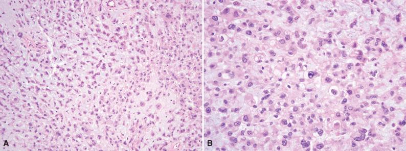 Figure 6.19, Myoepithelial Carcinoma of Soft Tissue.