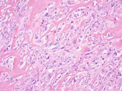 Figure 6.20, Myoepithelial Carcinoma of Soft Tissue.