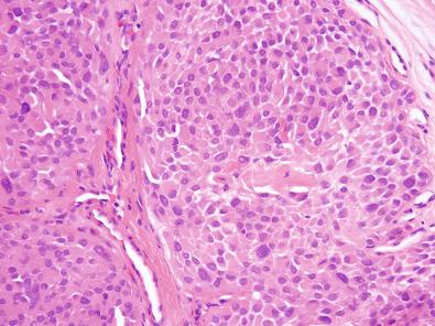 Figure 6.21, Myoepithelioma.