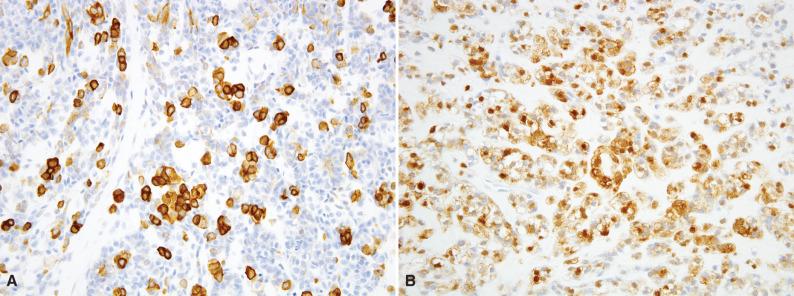 Figure 6.22, Myoepithelioma of Soft Tissue.