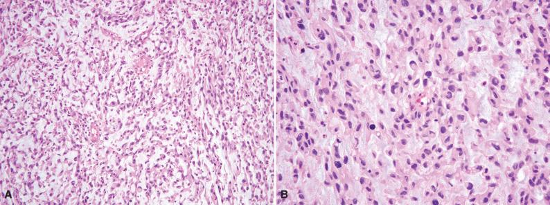 Figure 6.23, High-Grade Extraskeletal Myxoid Chondrosarcoma.