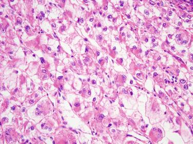 Figure 6.26, Epithelioid Angiomyolipoma (Perivascular Epithelioid Cell Tumor).