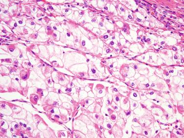 Figure 6.27, Epithelioid Angiomyolipoma (Perivascular Epithelioid Cell Tumor).