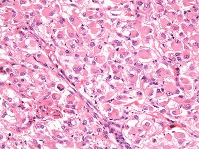 Figure 6.28, Perivascular Epithelioid Cell Tumor.