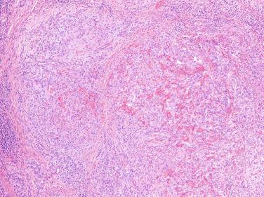 Figure 6.3, Epithelioid Hemangioma.